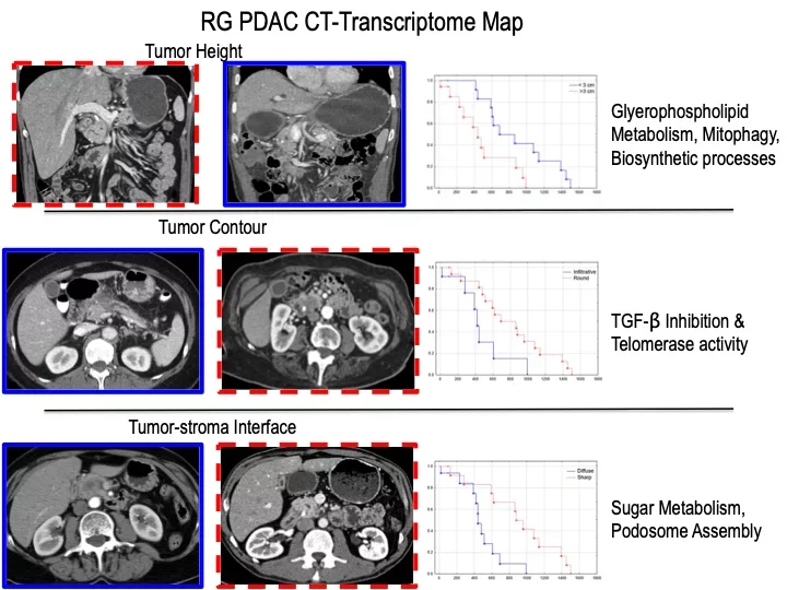 Three radiogenomic signatures for PDAC